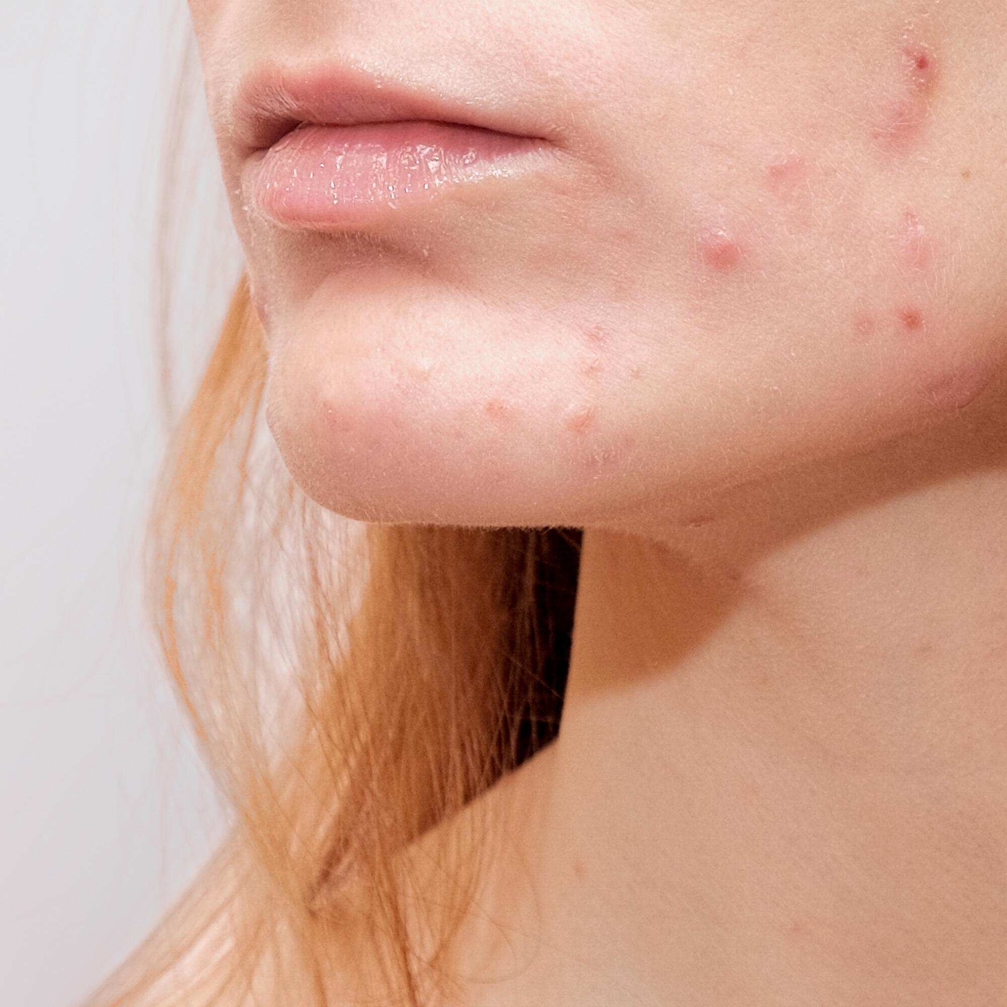 papules caused by allergic reaction